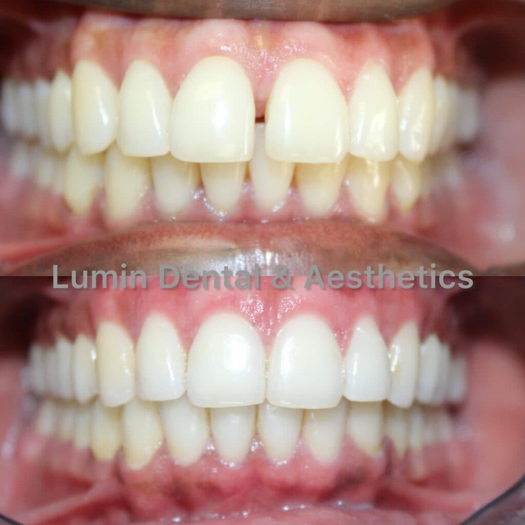 Diastema closure before and after result at Lumin Dental & Aesthetics